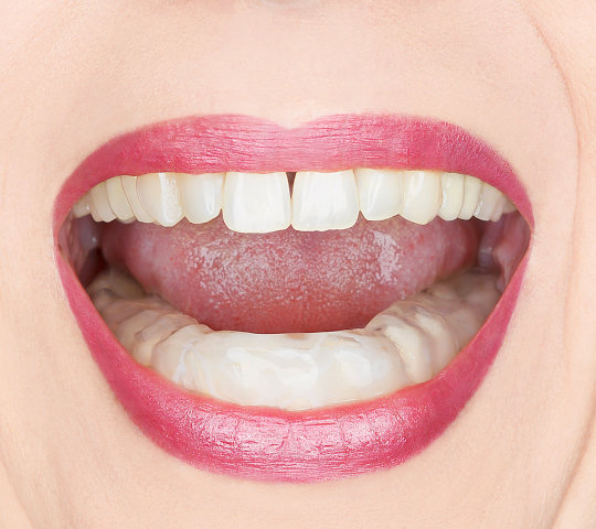 Closeup of an open woman`s mouth with plastic teeth guard
