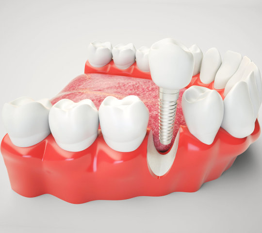 Dental implant on the example of a jaw model