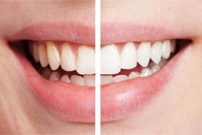 Comparison of teeth before and after bleaching session